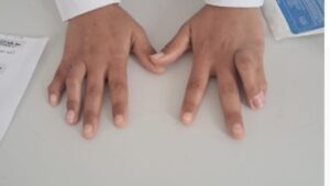 manos nino que fue operado medicos espanoles 69 686x386 1