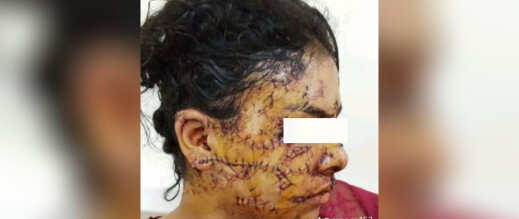 الأميرة-لالة-مريم-تتكفل-بعلاج-الشابة-إيمان-ضحية-الاعتداء-بتازة