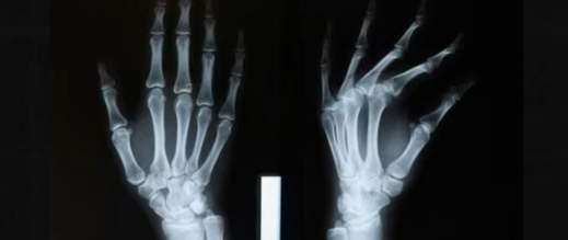 ثورة-طبية.-الصين-تخترع-غراء-لعلاج-كسور-العظام-في-ظرف-3-دقائق-فقط