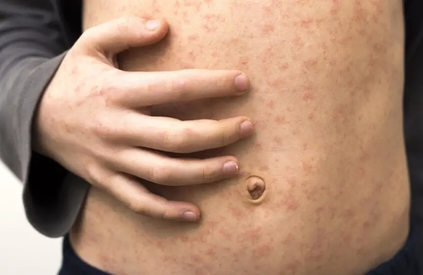 تفشي-وباء-الحصبة-في-إسرائيل-بوتيرة-متسارعة-وتسجيل-عدد-من-الوفيات-بين-الأطفال