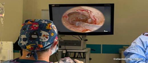 المغرب-يحقق-إنجازا-طبيا-نادرا:-أول-زراعة-قوقعة-سمعية-بتقنية-الأندوسكوب-في-المملكة